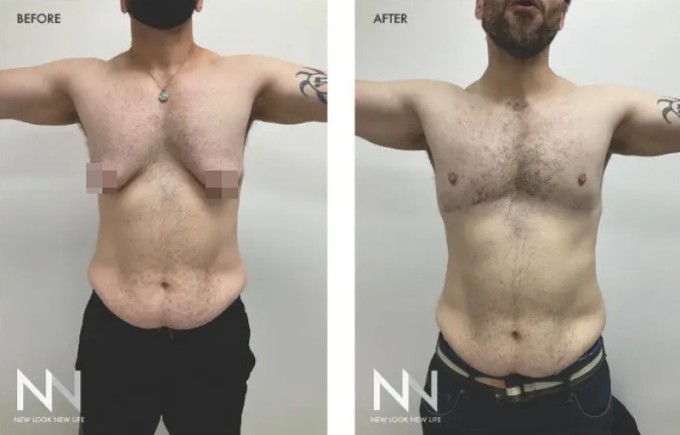 Gonzalez trước (trái) và sau phẫu thuật ngực. Ảnh: New Look New Life