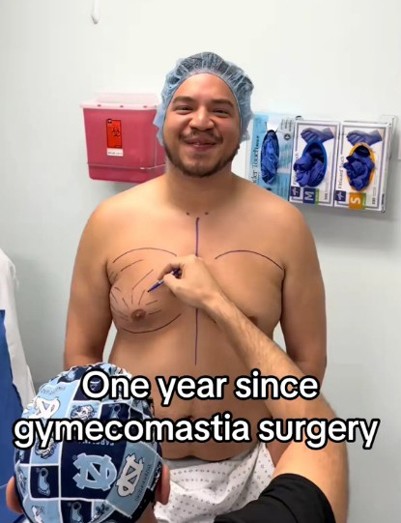 Kelbin Ramirez từng rất tự ti vì vòng ngực thừa. Ảnh: Kelbin Ramirez