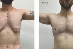 Đàn ông Mỹ chi hàng chục nghìn USD 'dao kéo' thu nhỏ ngực