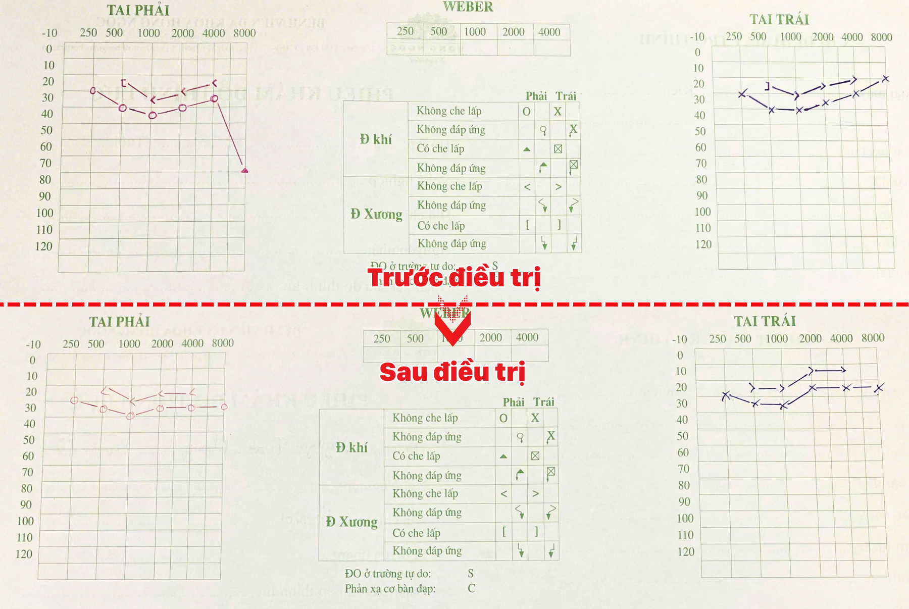 Kết quả đo thính lực đồ của bệnh nhân cải thiện rõ ràng một tuần điều trị