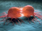 Những hiểu lầm tai hại về nguyên nhân gây ung thư