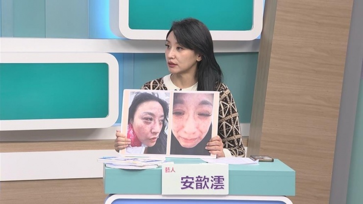 Ca sĩ Tâm Vân công khai ảnh chụp khuôn mặt bị bạo hành của mình. Ảnh: Chụp màn hình