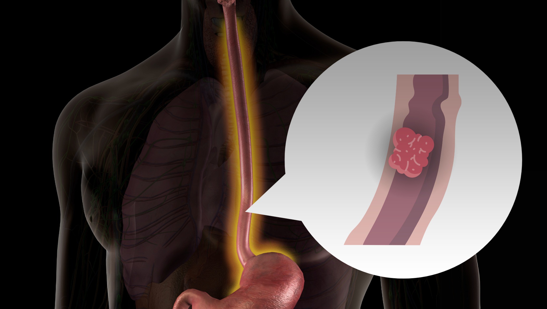 Những món người Việt yêu thích không ngờ làm tăng nguy cơ mắc ung thư thực quản - 2