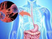 Những món người Việt yêu thích không ngờ làm tăng nguy cơ mắc ung thư thực quản