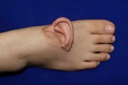 Tai đứt lìa được cấy lại sau 5 tháng 'nuôi' trên chân