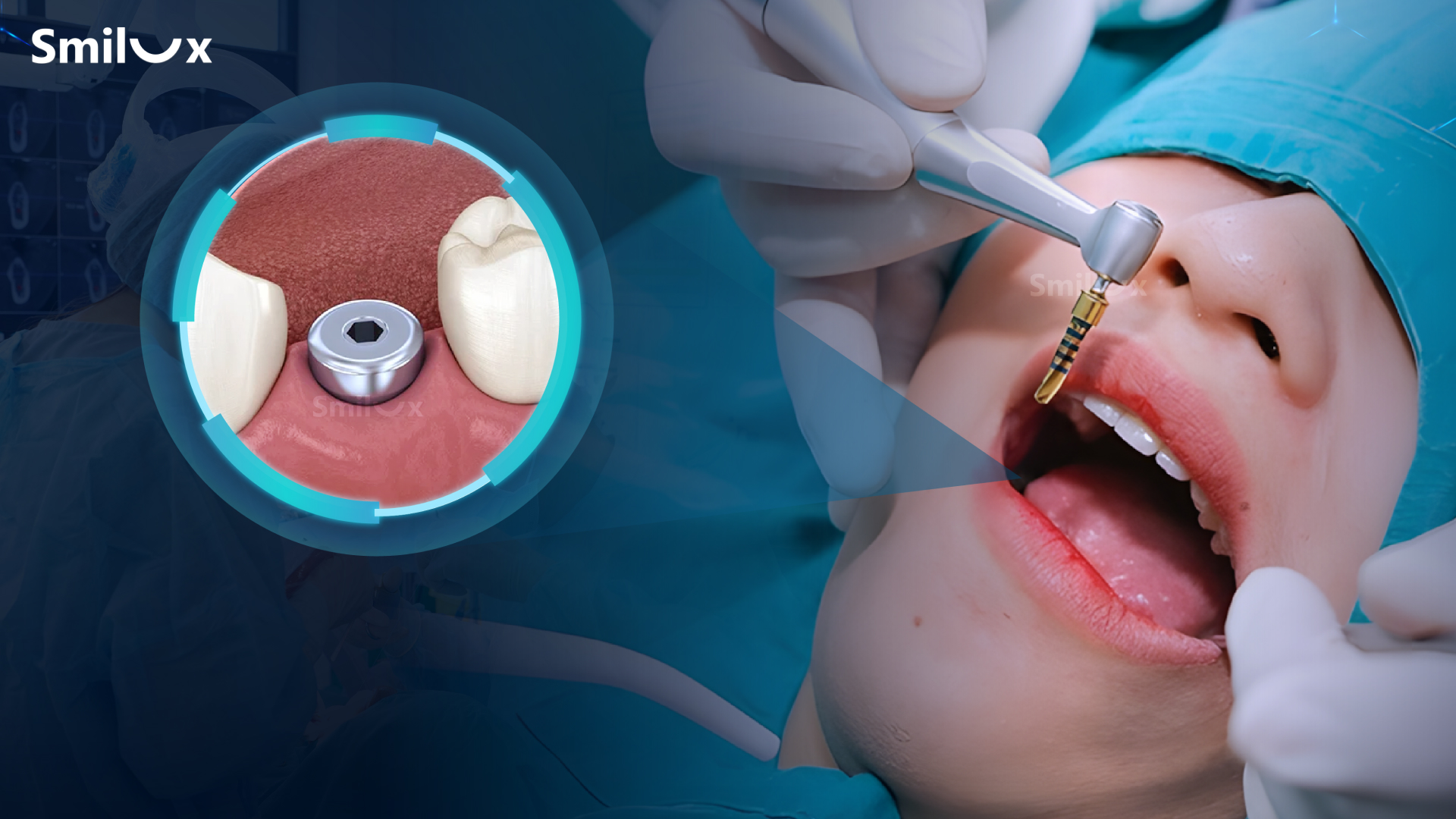 Nha khoa Smilux đột phá công nghệ trồng răng implant bắt vít định vị, không rạch lợi - 2