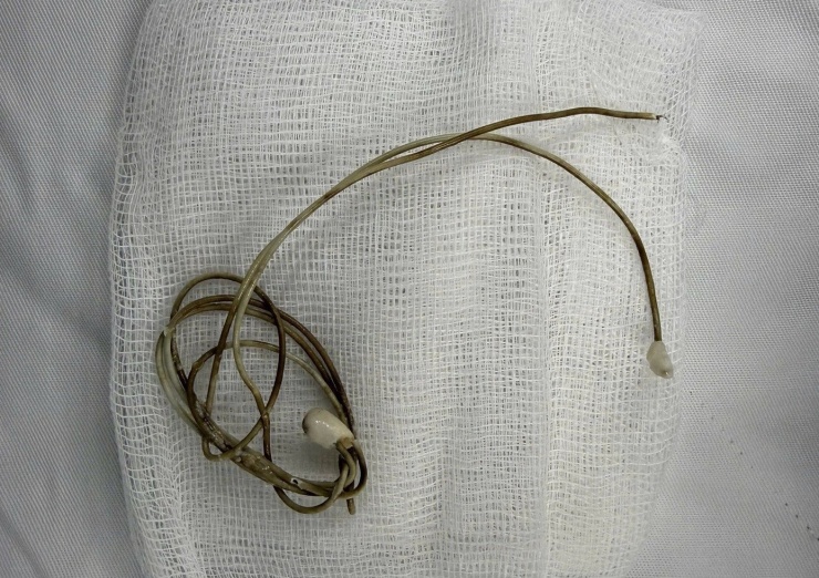 Dị vật là cuộn dây sạc điện thoại được bác sĩ lấy ra khỏi cơ thể người bệnh