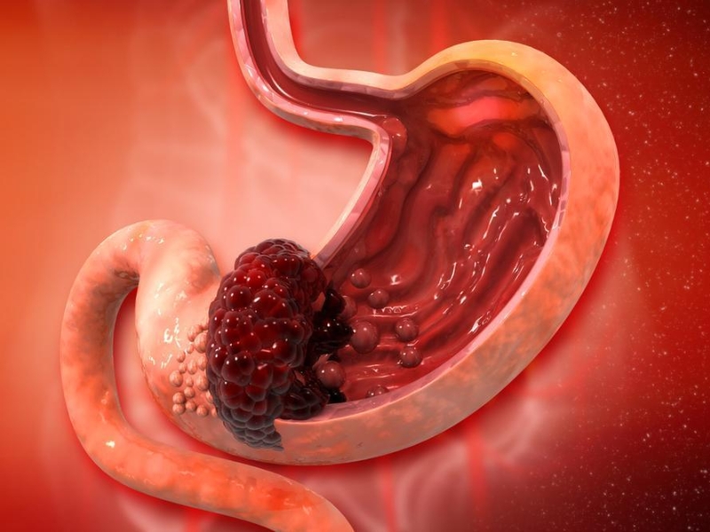 Nguyên nhân chính gây ung thư dạ dày liên quan mật thiết đến thói quen ăn uống không lành mạnh