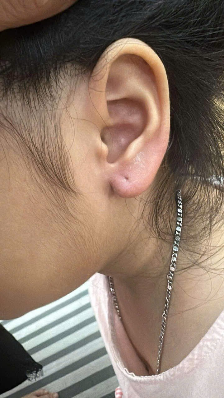 Hình ảnh bé gái sau khi bị tháo đôi bông tai.