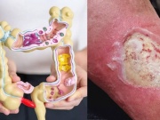 7 dấu hiệu trên da cảnh báo ung thư đại tràng, ai cũng cần biết