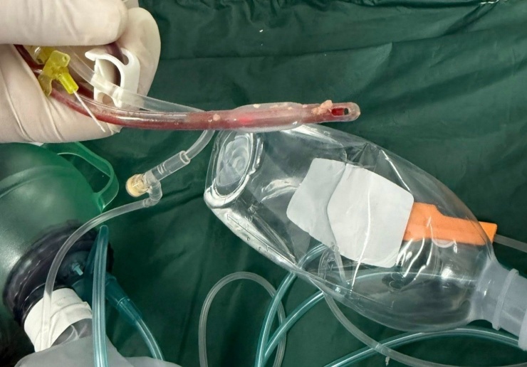 Thức ăn nghẹt dính vào ống nội khí quản của bệnh nhi. Ảnh: BSCC.
