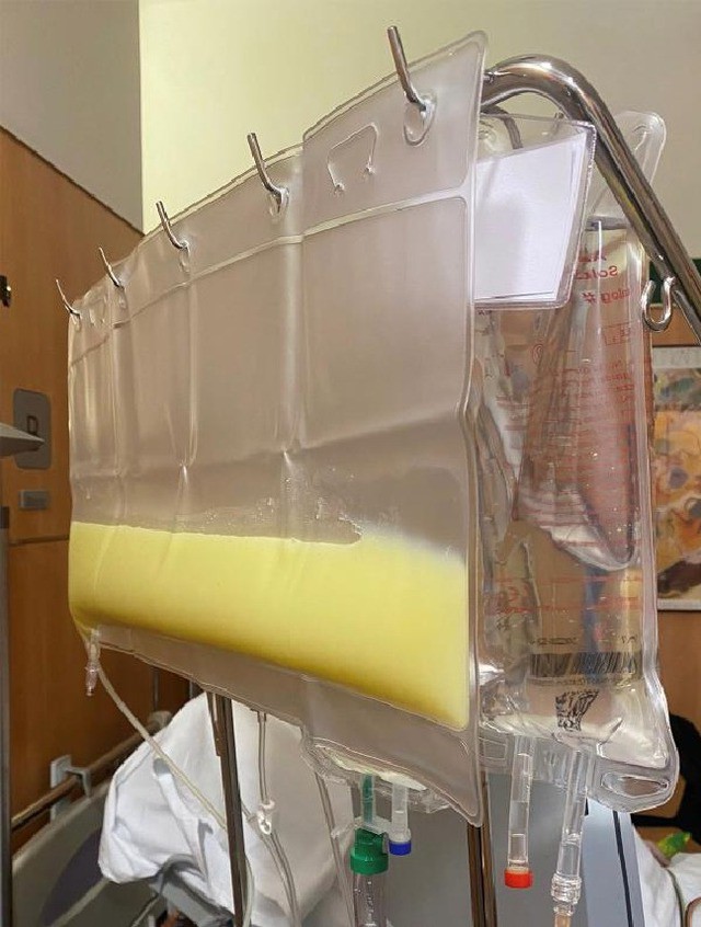 Các bác sĩ đã thay huyết tương, lọc máu liên tục, cứu sống bệnh nhân. Ảnh: BVCC