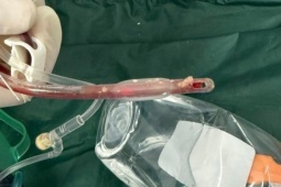 Bé gái 3 tuổi tử vong sau khi sặc thức ăn ở lớp