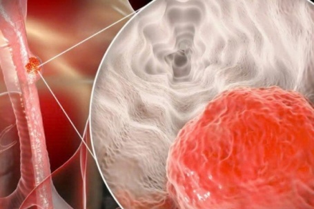 5 dấu hiệu ung thư thực quản dễ nhầm với bệnh khác, người Việt nên...