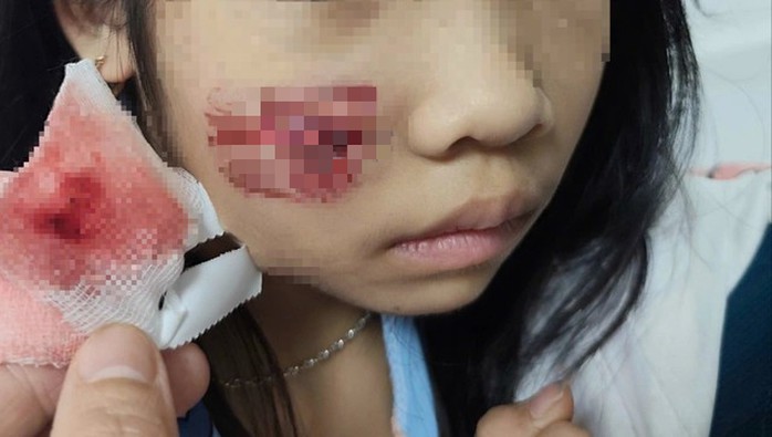 Vết thương do con khỉ gây ra với cháu bé.