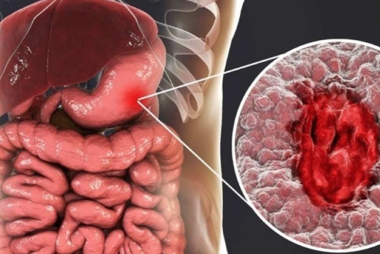 Người phụ nữ 41 tuổi phát hiện ung thư dạ dày từ dấu hiệu rối loạn tiêu hóa mà nhiều người Việt vẫn xem nhẹ