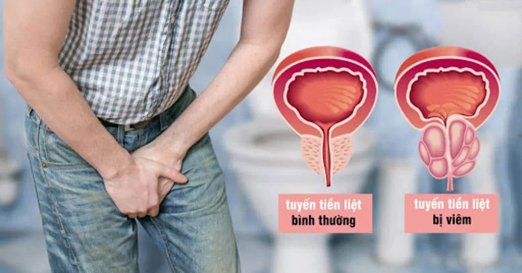 Những thói quen gây hại cho tuyến tiền liệt quý ông cần tránh - 2