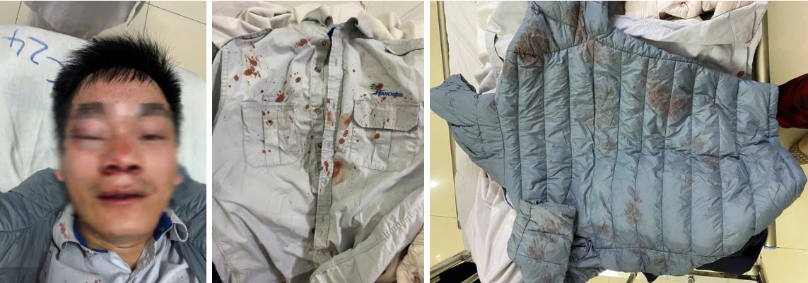 Hình ảnh tài xế P.T.V. và trang phục khi mới nhập viện