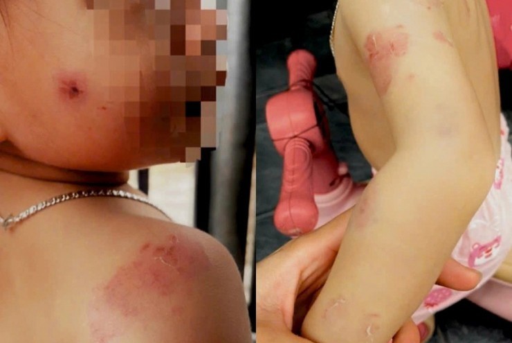 Bé gái 2 tuổi chi chít vết cắn, giáo viên nói ‘cô bao nhiêu là việc’