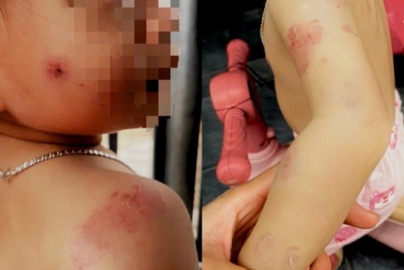 Bé gái 2 tuổi chi chít vết cắn, giáo viên nói ‘cô bao nhiêu là việc’