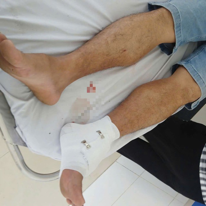 Vết thương trên chân một thầy giáo do bị cá sấu cắn