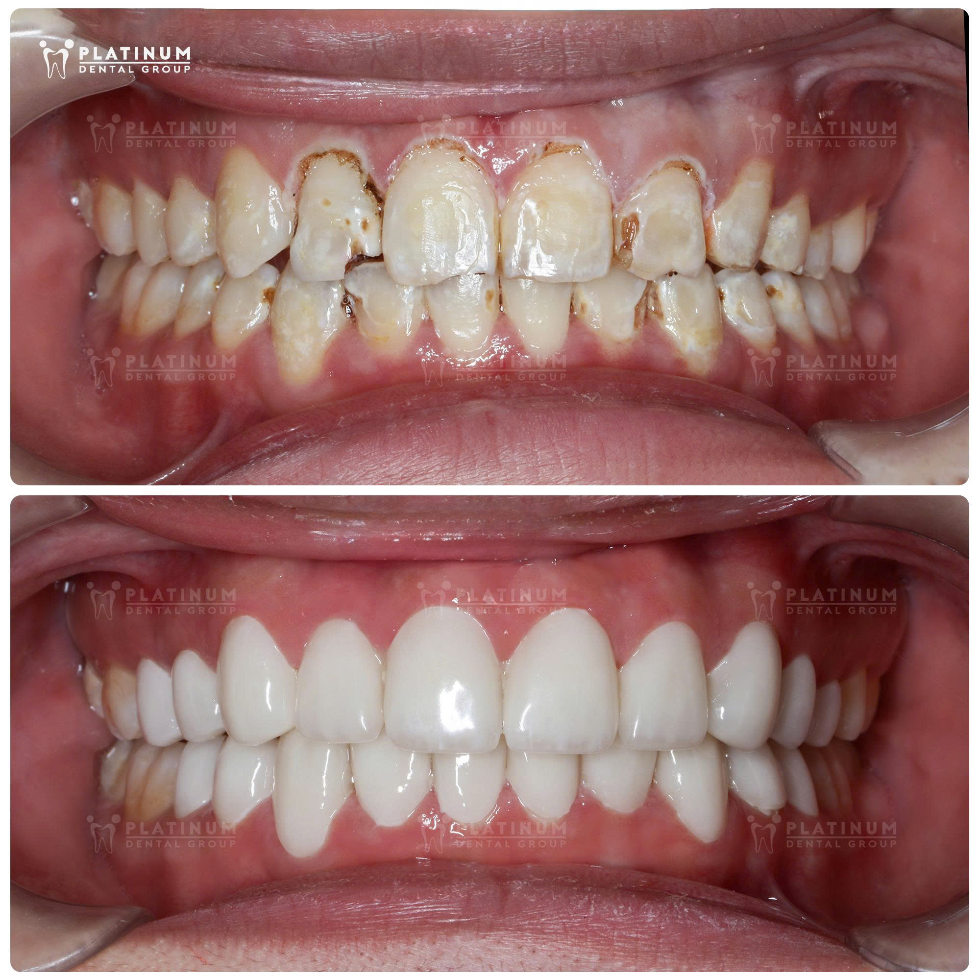 Răng có bệnh lý thiểu sản men, dễ vỡ cần bảo tồn bằng phương pháp mão sứ (Hình: Platinum Dental)