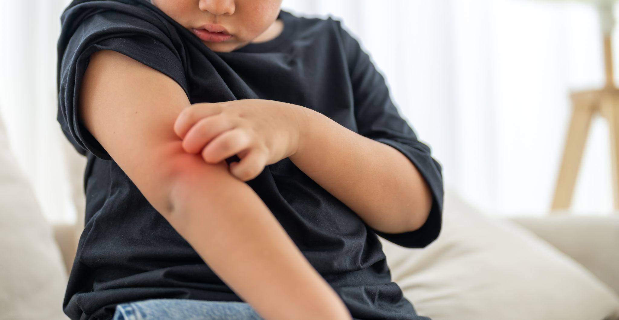 Trẻ bị muỗi mang mầm bệnh đốt có thể mắc bệnh viêm não Nhật Bản. Ảnh: Shutterstock