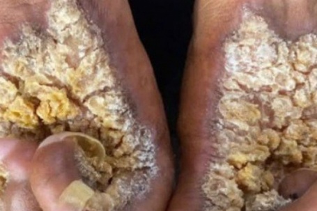 Người đàn ông thứ hai tại Việt Nam mắc hội chứng “người cây”