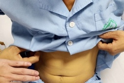 Người đàn ông trẻ suýt tử vong vì uống mật cá trắm để tăng sinh lực