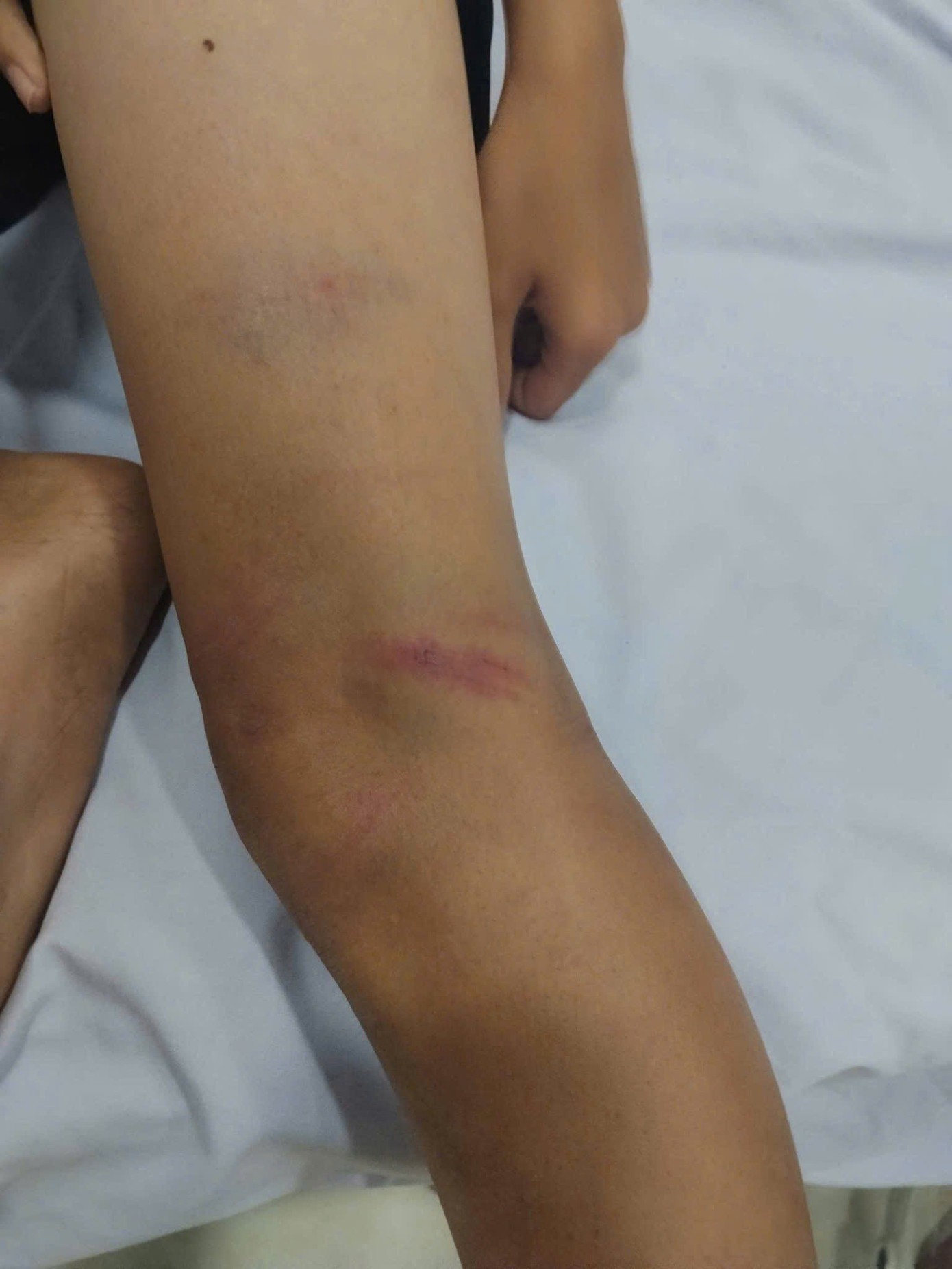 Các cháu bị thương tích, bầm tím nhiều nơi trên cơ thể.