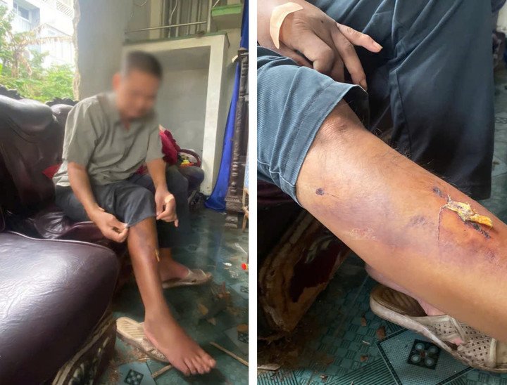 Theo ông H. đây không phải lần đầu ông bị nhóm người trẻ tuổi trên vô cớ đánh đập, trên chân và tay ông hiện còn nhiều vết thương, bầm tím được cho là do nhóm người này gây ra. (Ảnh: Vi Thảo)