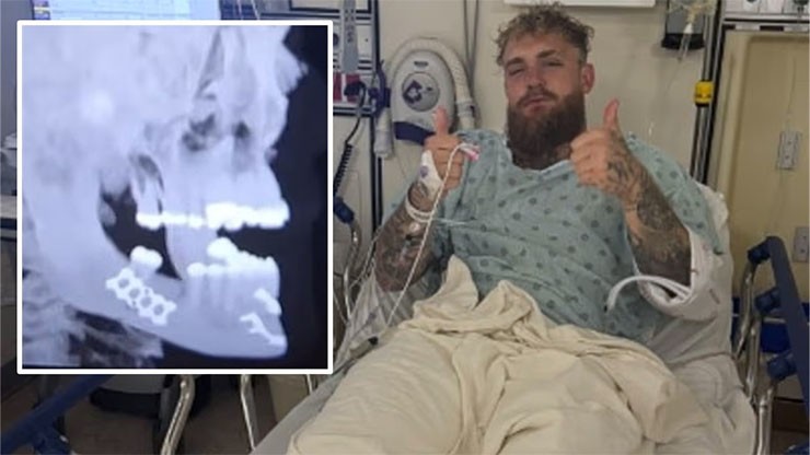 Chấn thương của&nbsp;Jake Paul