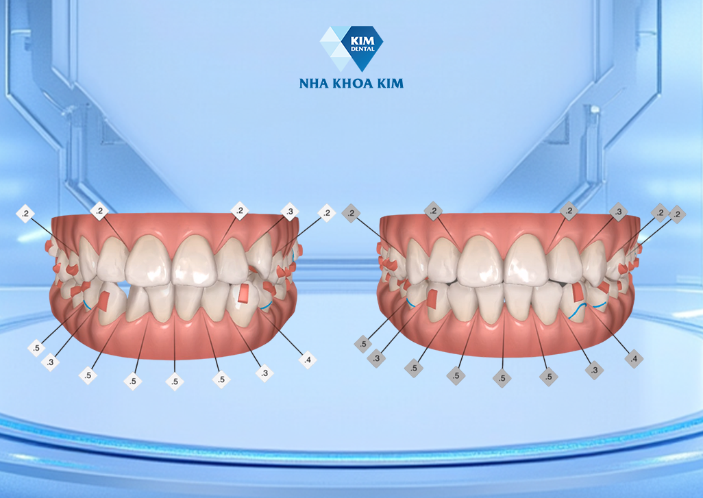 Công nghệ AI mô phỏng kết quả sau khi niềng răng tại Nha Khoa Kim