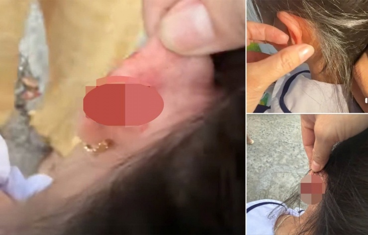 Học sinh lớp 1 bị cô giáo véo chảy máu tai.