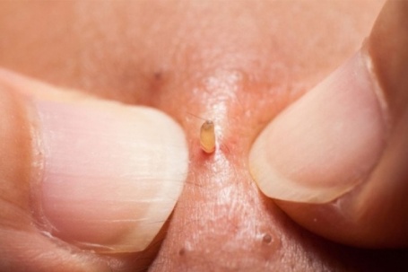 7 lý do nhiều người nghiện xem clip nặn mụn dù trông rất ghê