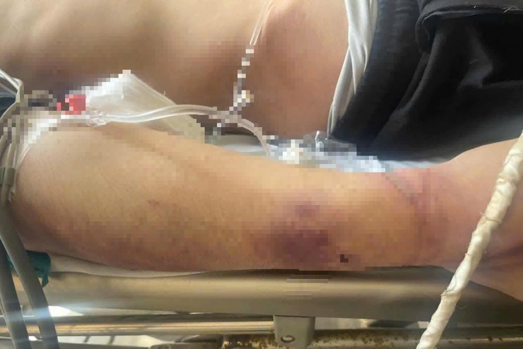 Nhiều vết thương bầm tím trên cơ thể học viên N. Ảnh: Đ.X