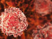 Tế bào ung thư phát triển thế nào trong cơ thể? Hiểu đúng để giảm nguy cơ mắc bệnh