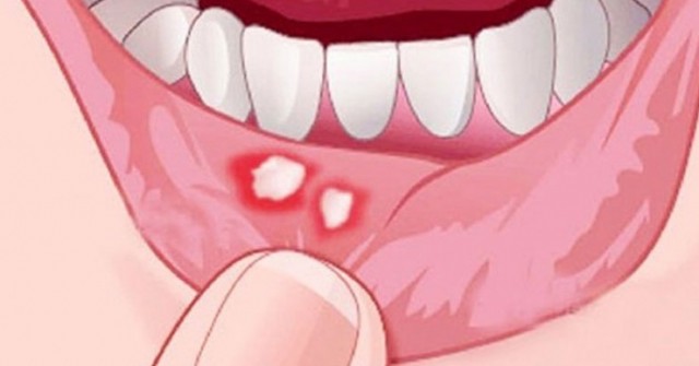 Mùa đông hay bị loét miệng, đừng chủ quan vì có thể là dấu hiệu của bệnh nguy hiểm