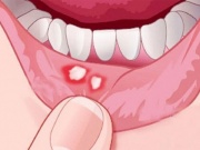 Mùa đông hay bị loét miệng, đừng chủ quan vì có thể là dấu hiệu của bệnh nguy hiểm