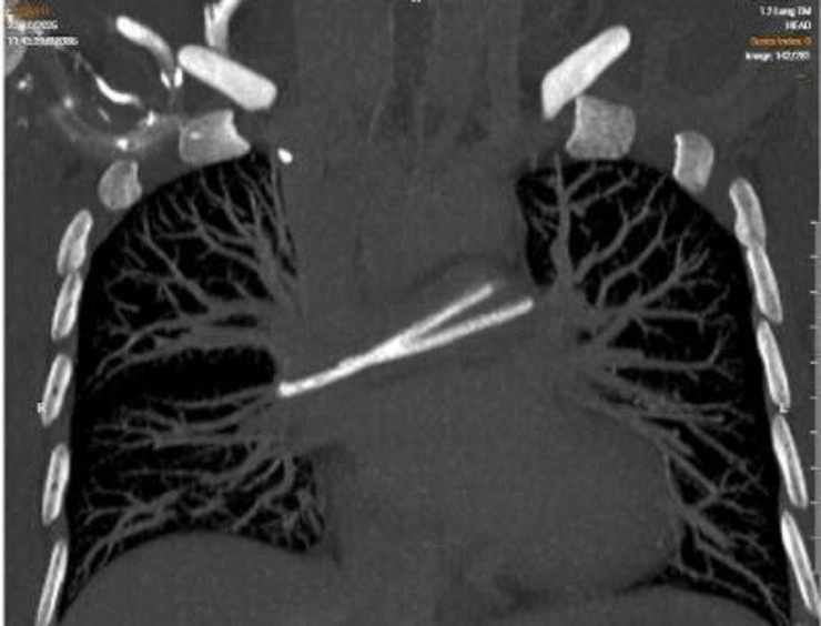 Hình ảnh kiểm tra ghi nhận dị vật bị đứt trôi vào tim đe dọa trực tiếp tính mạng người bệnh