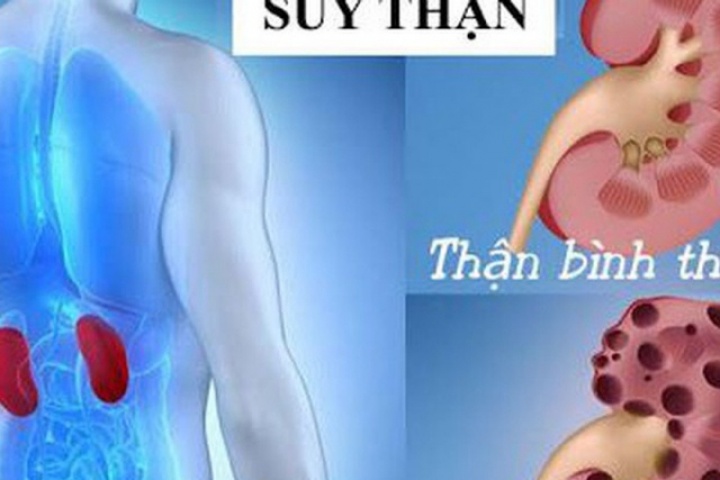 7 thói quen đơn giản giúp giảm nguy cơ suy thận người Việt nên làm