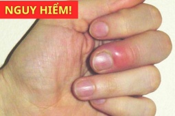 Tin tức sức khỏe - Phát hiện phổi “gặp nguy hiểm” nhờ 3 dấu hiệu trên ngón tay mà nhiều người thường bỏ qua!