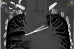 Ống truyền hóa chất trôi vào tim, bị 'bỏ quên' nhiều năm trong cơ thể