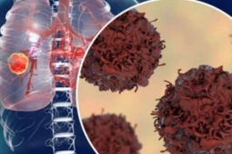 Xét nghiệm tưởng mang thai, nào ngờ mắc ung thư hiếm gặp, thế giới ghi nhận dưới 200 ca