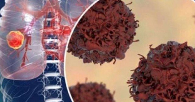 Xét nghiệm tưởng mang thai, nào ngờ mắc ung thư hiếm gặp, thế giới ghi nhận dưới 200 ca