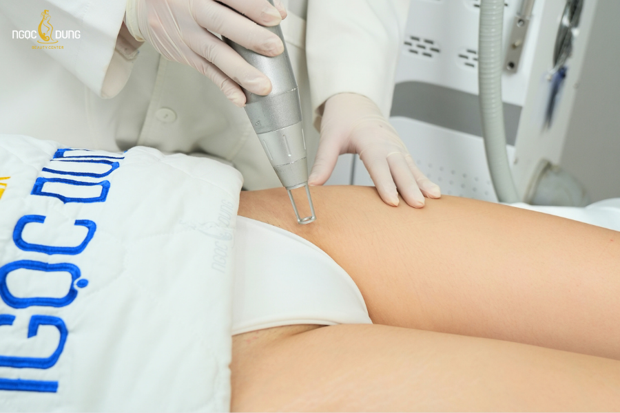 Triệt lông bằng công nghệ New E-Light làm suy yếu nang lông hiệu quả