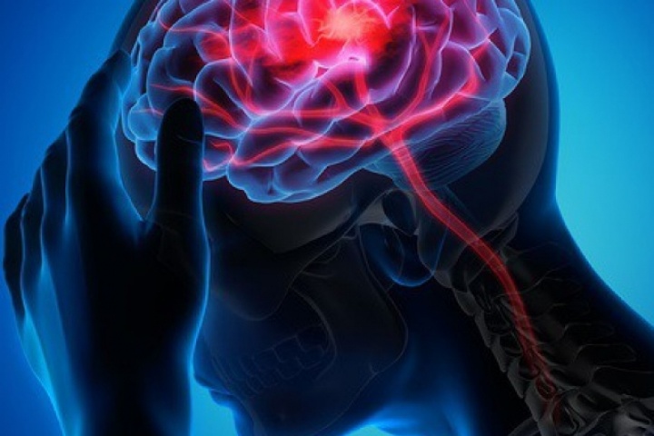 Đột quỵ gia tăng: Nghiên cứu Mỹ hé lộ thủ phạm mới
