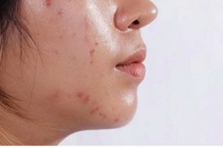 Bí quyết làm sạch dầu trên da mặt mà nhiều người bỏ qua