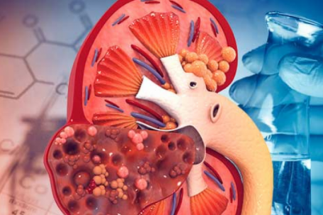 5 dấu hiệu suy thận sớm thường bị nhầm là do mệt mỏi, tuổi tác, người Việt nên biết để phòng bệnh