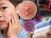 Bé trai 3 tuổi bị sùi mào gà trên mặt, bác sỹ nói do dùng chung khăn tắm
